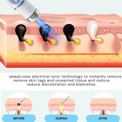 🔥【OFFICIAL STORE】LOVILDS™ Non-Invasive Mole and Wart Removal Laser Pen