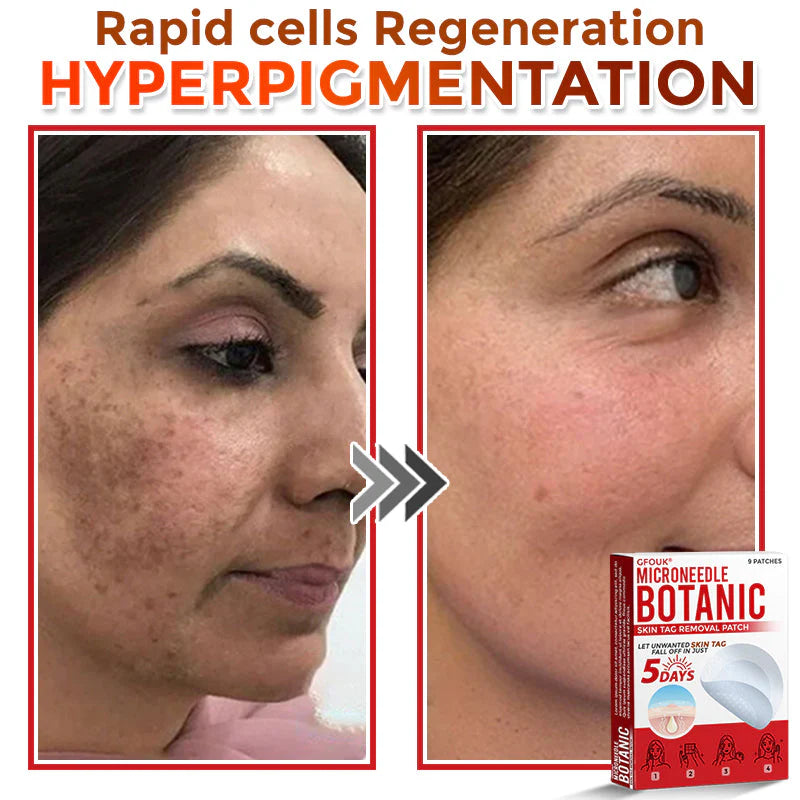 🔥🌻GFOUK® MicroNeedle Botanic Skin Tag Removal Patch 🇺🇸 Made in the USA