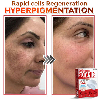 🔥🌻GFOUK® MicroNeedle Botanic Skin Tag Removal Patch 🇺🇸 Made in the USA