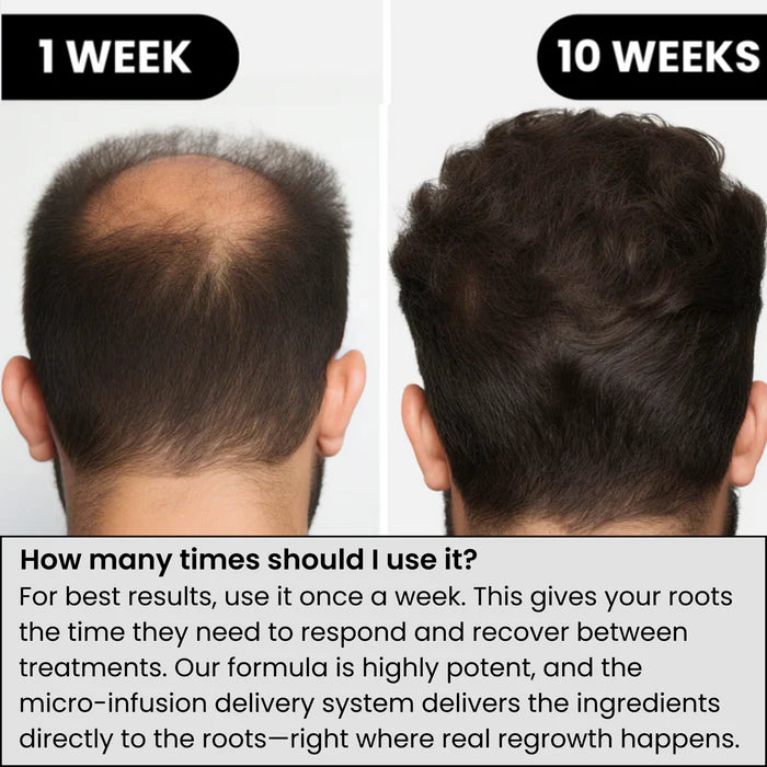 AlphaInfuse™ Hair Regrowth System